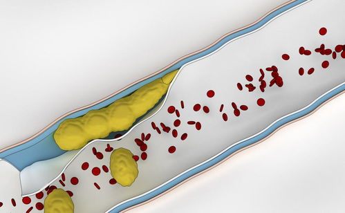 控制飲食降低壞血脂 健康投資與醫療費用節約的雙贏策略
